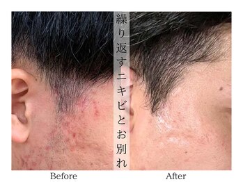 リララ(lelala)/ビフォーアフター☆