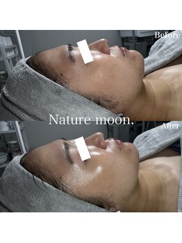 ナチュールムーン(Nature moon.)/ハーブピーリング after