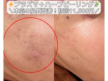 ベルファーム(Belle Femme)/本気のニキビ肌卒業！贅沢ケア☆