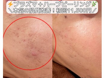 ベルファーム(Belle Femme)/本気のニキビ肌卒業！贅沢ケア☆