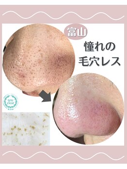 サロン リュンヌ(salon lune)/毛穴エクストラクション