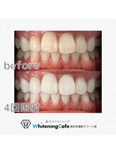 ホワイトニングカフェ 高松丸亀町グリーン店(WhiteningCafe)/