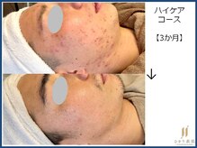 ひかり素肌/ハイケアコース 3か月