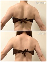 リリィブラン(Lily branc)/部位集中痩身/背中+肩+二の腕