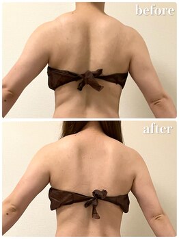 リリィブラン(Lily branc)/部位集中痩身/背中+肩+二の腕