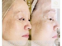 ウルワシ(Uruwashi)/ハーバルモアハーブピーリング