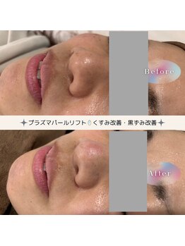 ディアー(Dear)/プラズマパールリフト