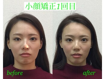 オズ六本木/小顔モニター1回目@オズ六本木