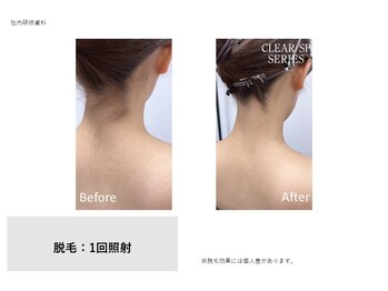 トータルクリア(TOTAL CLEAR)/女性うなじ脱毛