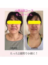 わたしの/小顔矯正