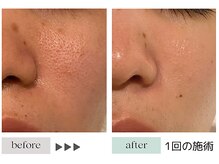 ジェニックサロン グランギンザ 水戸(GENIC SALON GRAND GINZA)/最先端◎細胞美容/毛穴/角栓
