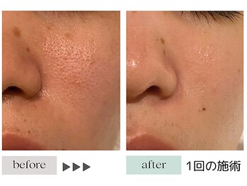 ジェニックサロン グランギンザ 水戸(GENIC SALON GRAND GINZA)/最先端◎細胞美容/毛穴/角栓