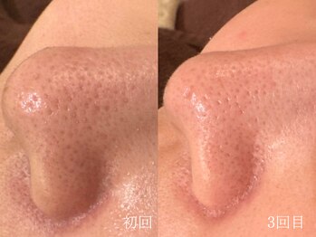 ウォーム(warm)/毛穴/毛穴洗浄/毛穴ケア/毛穴