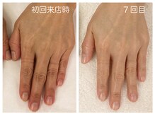 キレイテ 上野店/40代/7回目【ハンドケア上野】