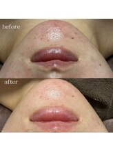 リメレ(Rimere)/ハーブピーリング×プラズマ