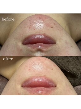 リメレ(Rimere)/ハーブピーリング×プラズマ