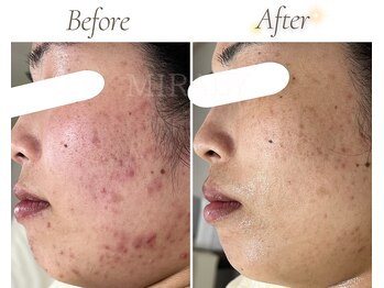 ミラリー(MIRALY)/赤み肌荒れ跡ケア 6ヶ月(20代)