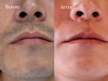 イースト(EAST)/ヒゲ脱毛10回以上