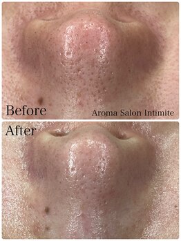 アンティミテ(Intimite)/毛穴洗浄1回の変化