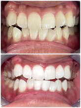 アミュホワイトニング/医療提携ホワイトニング