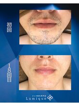 ルミーク(Lumique)/Before After S様