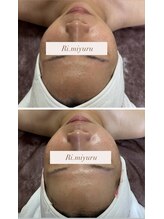 リミュール(Ri.miyuru)/キュッと締まった潤いハリ肌