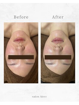 サロンモア(salon More)/陶肌トリートメント 1回