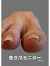 【巻き爪モニター】指2本→特別価格¥5,500