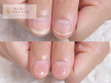 深爪矯正 爪悩み専門店 cocomo/(深爪/長さだし/フィルイン)
