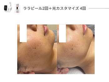 スパレーカ(Spa laka)/光カスタマイズ＋ララピール