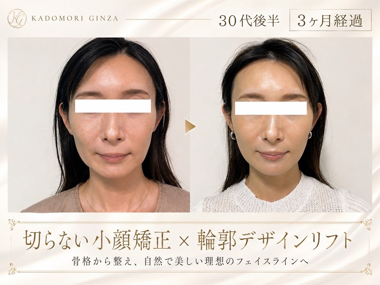 小顔 美容鍼 銀座に関するサロン KUMANOMI美容鍼灸 銀座院など