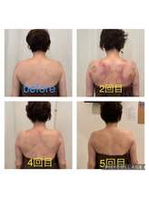 サクラプラス(SAKURA Plus)/骨格美容整体カッピング