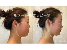 エルビア エステ ドゥ パリ(Elevia Esthe de Paris)/結果出し小顔