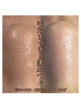サロンドオフ 西梅田(salon de off)/毛穴ケアのビフォーアフター*