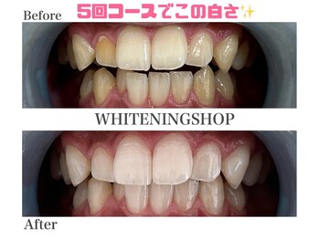 ホワイトニングショップ 名古屋店/【ビフォーアフター】5回コース