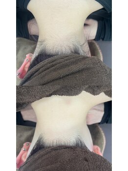 ミース 仙台長町店/うなじ矯正●ビフォーアフター