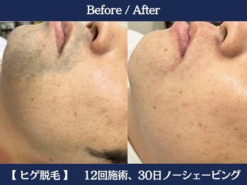 ランドマーク 中崎町(LANDMARK.)/《 口周り・ほほ 》