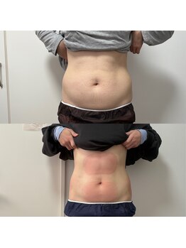 ミージュ(Miiju.)/お腹ほっそり!脂肪冷却4カップ