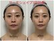 フェムプリュ(femplus)の写真/【人気No.1】小顔.美肌get!クリニックに匹敵する結果出し!『サーモシェイプopas』二重顎/シワ/たるみ即改善