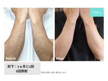 ティエル(TieLu)/腕脱毛