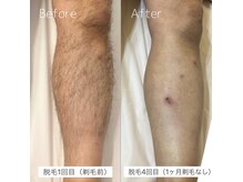 結果重視！最新美容脱毛機でツルスベ肌に♪