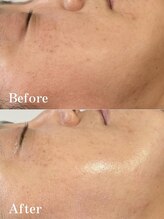 エアレ(eare)/REVlビフォーアフター