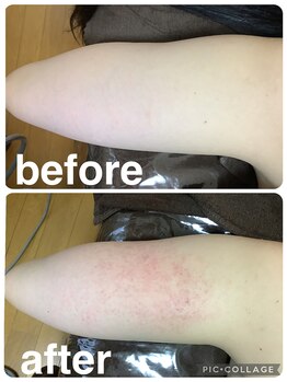 ギンザアール(GINZA R.)/二の腕に徹底アプローチ◎