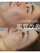 ココリール/アンストレス×光フェイシャル