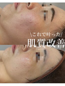 ココリール/アンストレス×光フェイシャル