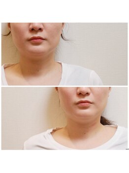 ル フラーズ(Les Fleurs)/食いしばりで鼻が大きくなる