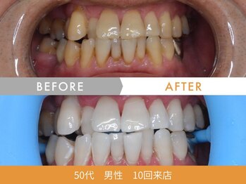 ホワイトニングセンター 札幌白石/ホワイトニングビフォーアフター