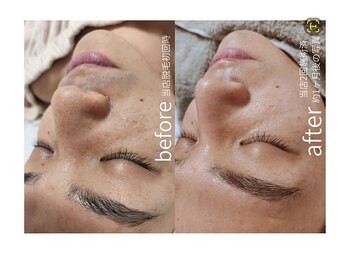 キレイラボ(Ki-Re-i LABO)/ハイドラ+ハーブピーリング