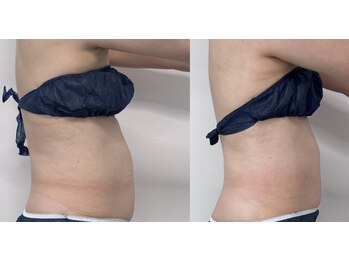 ノニュ(NONYU)/ウェーブテラピー