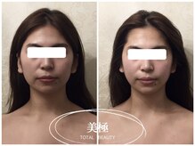 美極 トータルビューティー(美極 TOTAL BEAUTY)/恵比寿/小顔コルギ/エステ/